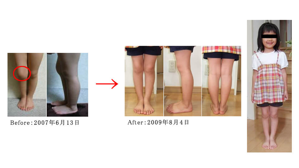膝関節の骨軟骨腫（4歳女児）｜ 健康相談会の治癒例